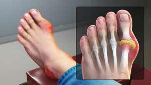 Bệnh gout chữa được không? Cách trị & ngăn ngừa biến chứng bệnh gout
