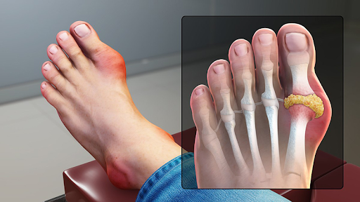 Bệnh gout chữa được không? Cách trị & ngăn ngừa biến chứng bệnh gout