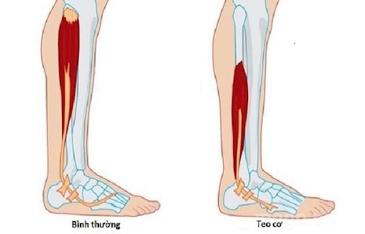 Dấu hiệu nhận biết bệnh teo cơ
