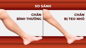 Nguyên nhân gây teo cơ