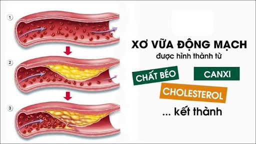 Tăng cholesterol gây xơ vữa động mạch