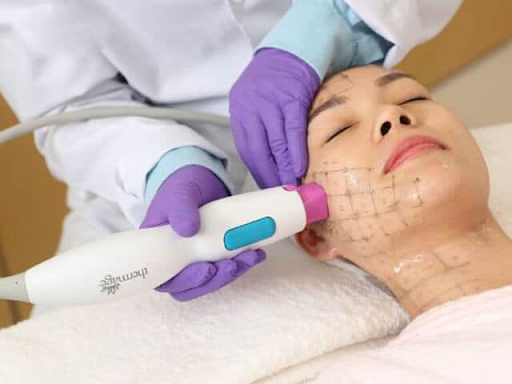 Tiêm nội mô vi điểm bằng thiết bị